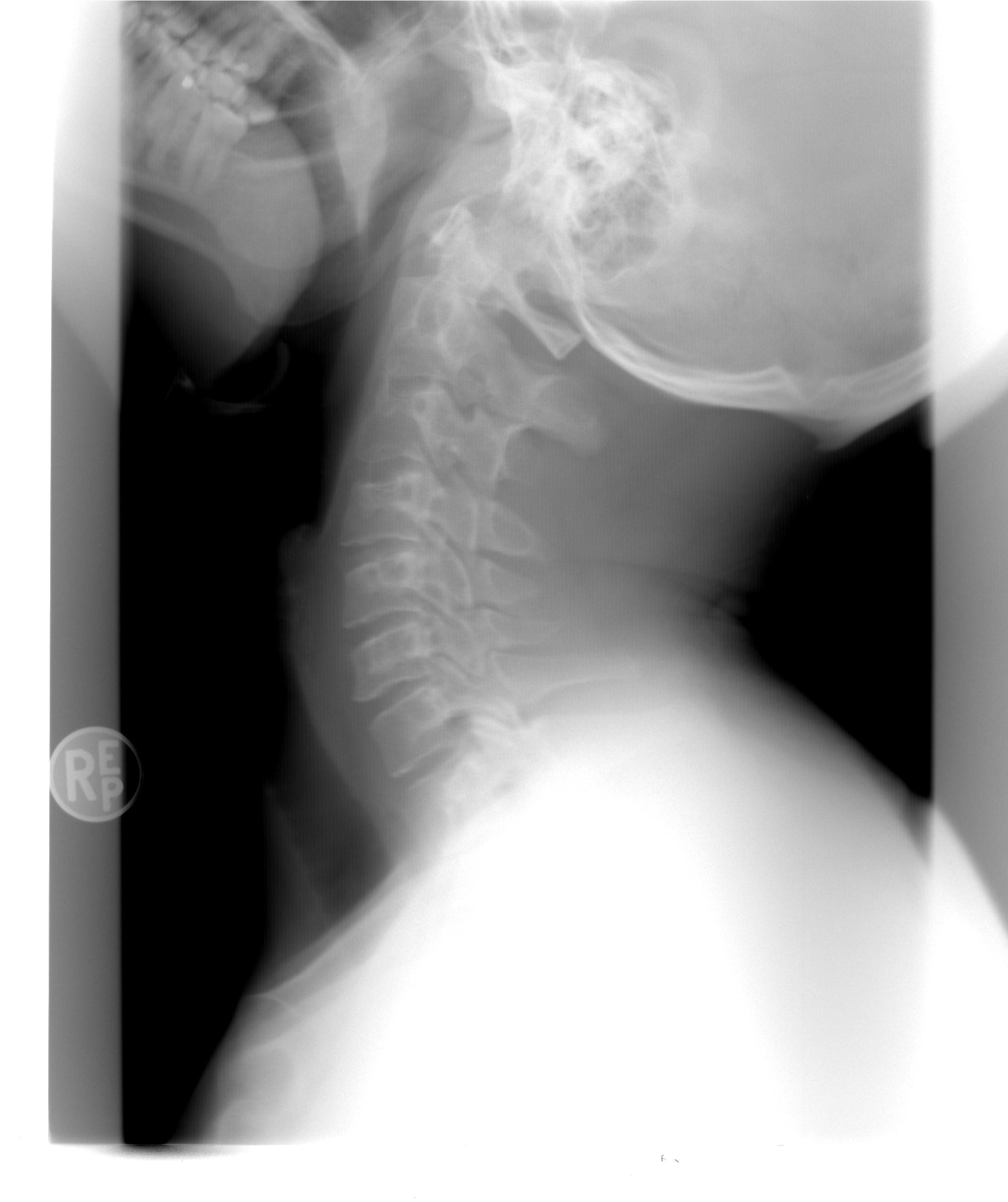 Neck x-ray result