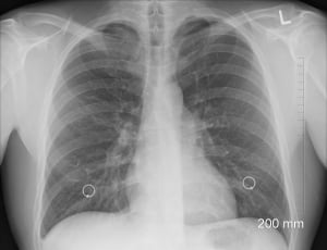 human lung xray thumbnail