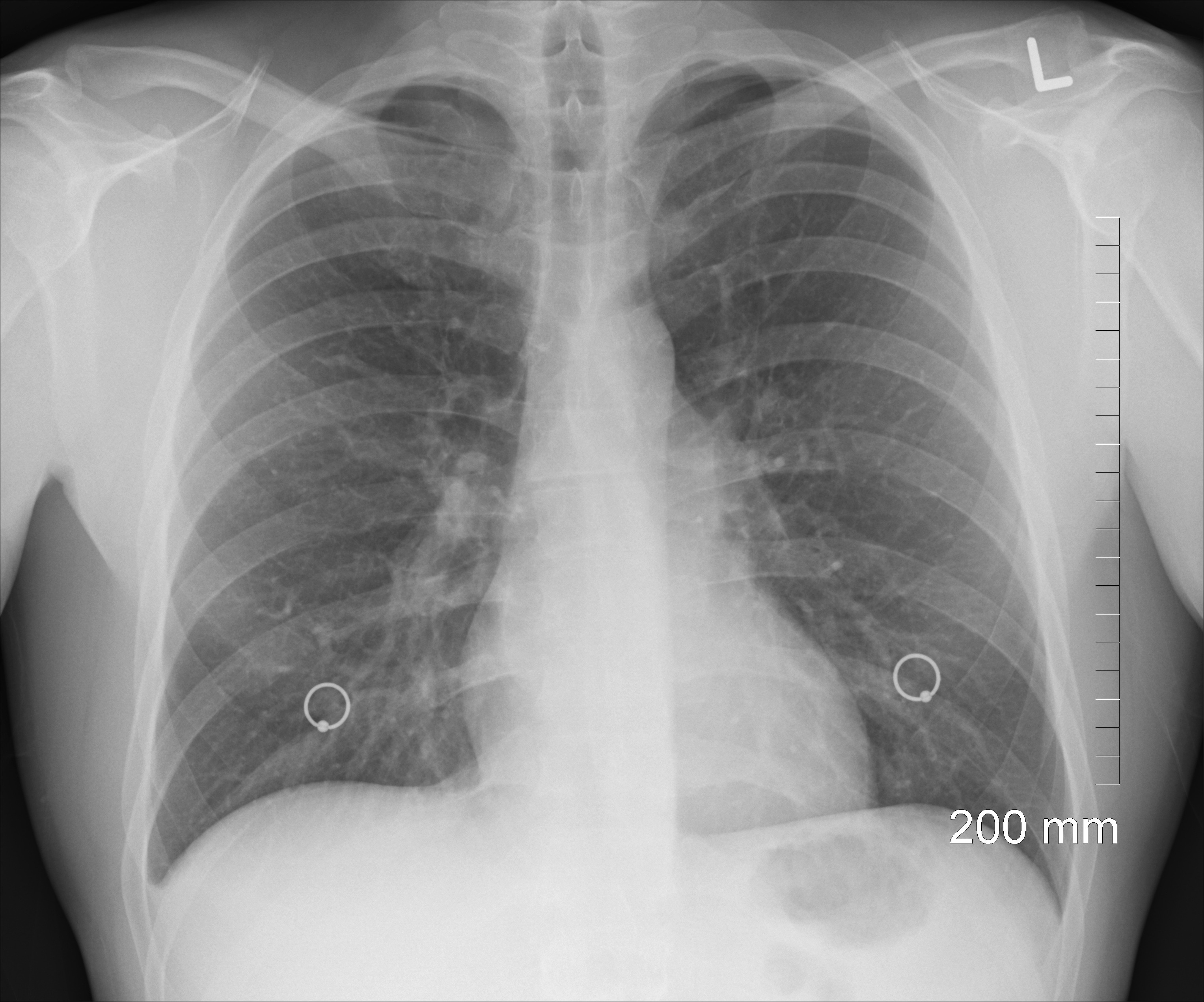 human lung xray