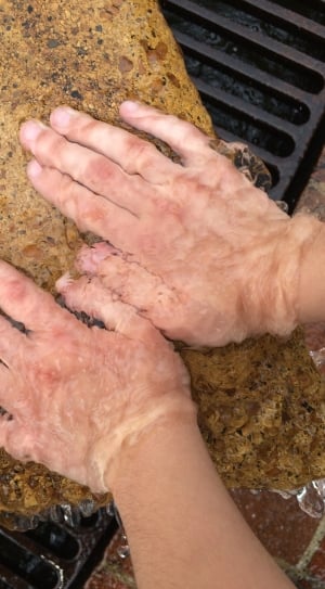 human hand skin condition thumbnail