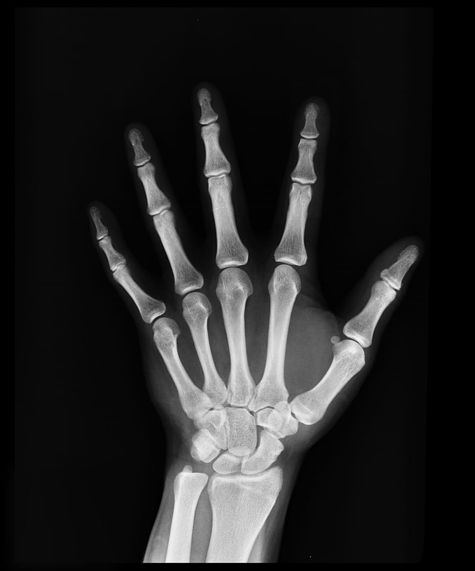 left human hand xray preview